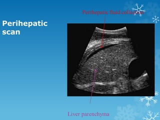 Perihepatic
scan
 