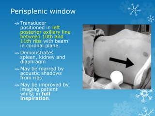 Perisplenic window
 Transducer
positioned in left
posterior axillary line
between 10th and
11th ribs with beam
in coronal plane.
 Demonstrates
spleen, kidney and
diaphragm
 May be marred by
acoustic shadows
from ribs
 May be improved by
imaging patient
whilst in full
inspiration.
 