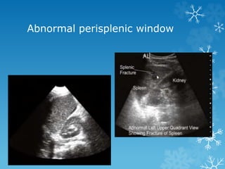 Abnormal perisplenic window
 