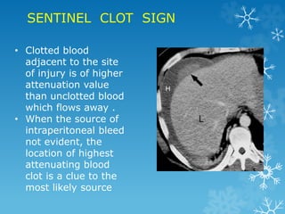 SENTINEL CLOT SIGN
• Clotted blood
adjacent to the site
of injury is of higher
attenuation value
than unclotted blood
which flows away .
• When the source of
intraperitoneal bleed
not evident, the
location of highest
attenuating blood
clot is a clue to the
most likely source
 