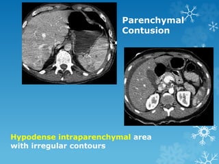Parenchymal
Contusion
Hypodense intraparenchymal area
with irregular contours
 