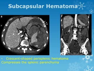 Subcapsular Hematoma
• Crescent-shaped perisplenic hematoma
Compresses the splenic parenchyma
 