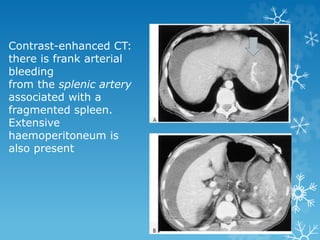 Contrast-enhanced CT:
there is frank arterial
bleeding
from the splenic artery
associated with a
fragmented spleen.
Extensive
haemoperitoneum is
also present
 