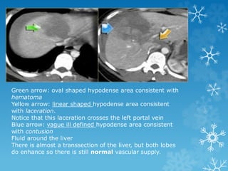 Green arrow: oval shaped hypodense area consistent with
hematoma
Yellow arrow: linear shaped hypodense area consistent
with laceration.
Notice that this laceration crosses the left portal vein
Blue arrow: vague ill defined hypodense area consistent
with contusion
Fluid around the liver
There is almost a transsection of the liver, but both lobes
do enhance so there is still normal vascular supply.
 
