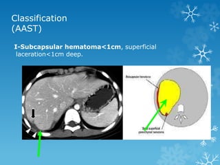 Classification
(AAST)
I-Subcapsular hematoma<1cm, superficial
laceration<1cm deep.
 