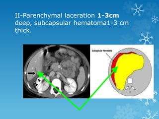 II-Parenchymal laceration 1-3cm
deep, subcapsular hematoma1-3 cm
thick.
 