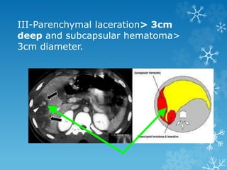 III-Parenchymal laceration> 3cm
deep and subcapsular hematoma>
3cm diameter.
 