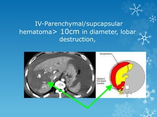IV-Parenchymal/supcapsular
hematoma> 10cm in diameter, lobar
destruction,
 