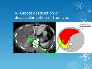 V- Global destruction or
devascularization of the liver.
 
