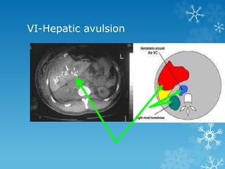 VI-Hepatic avulsion
 