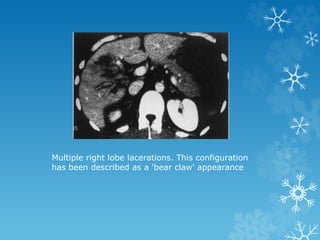 Multiple right lobe lacerations. This configuration
has been described as a 'bear claw' appearance
 