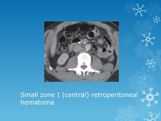 Small zone I (central) retroperitoneal
hematoma
 