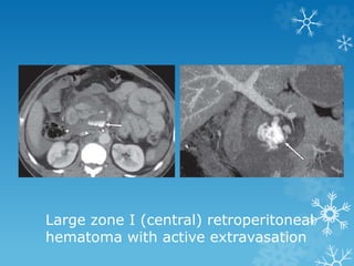 Large zone I (central) retroperitoneal
hematoma with active extravasation
 