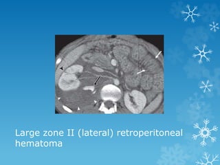 Large zone II (lateral) retroperitoneal
hematoma
 