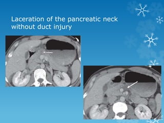 Laceration of the pancreatic neck
without duct injury
 