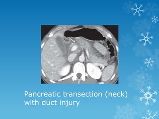 Pancreatic transection (neck)
with duct injury
 