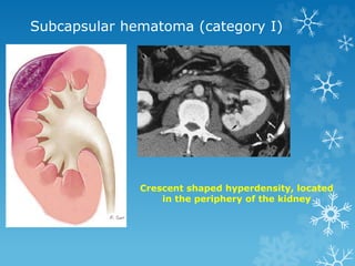 Subcapsular hematoma (category I)
Crescent shaped hyperdensity, located
in the periphery of the kidney
 
