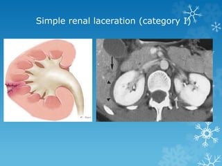 Simple renal laceration (category I)
 