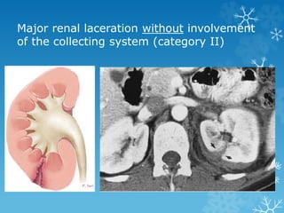 Major renal laceration without involvement
of the collecting system (category II)
 