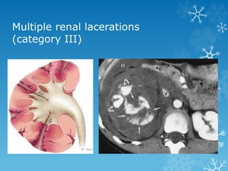 Multiple renal lacerations
(category III)
 