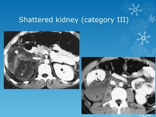 Shattered kidney (category III)
 