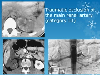 Traumatic occlusion of
the main renal artery
(category III)
 