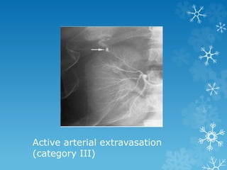 Active arterial extravasation
(category III)
 
