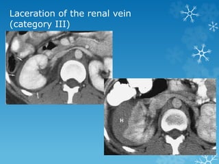 Laceration of the renal vein
(category III)
 