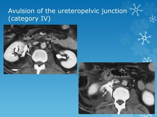 Avulsion of the ureteropelvic junction
(category IV)
 