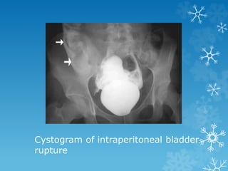 Cystogram of intraperitoneal bladder
rupture
 