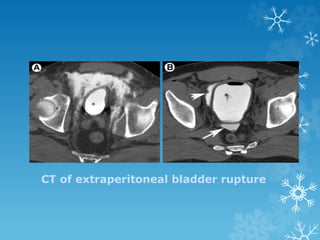 CT of extraperitoneal bladder rupture
 