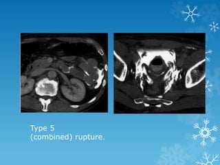 Type 5
(combined) rupture.
 
