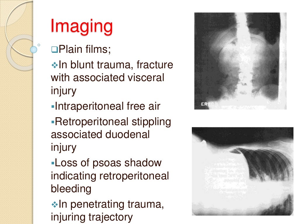 abdominal trauma
