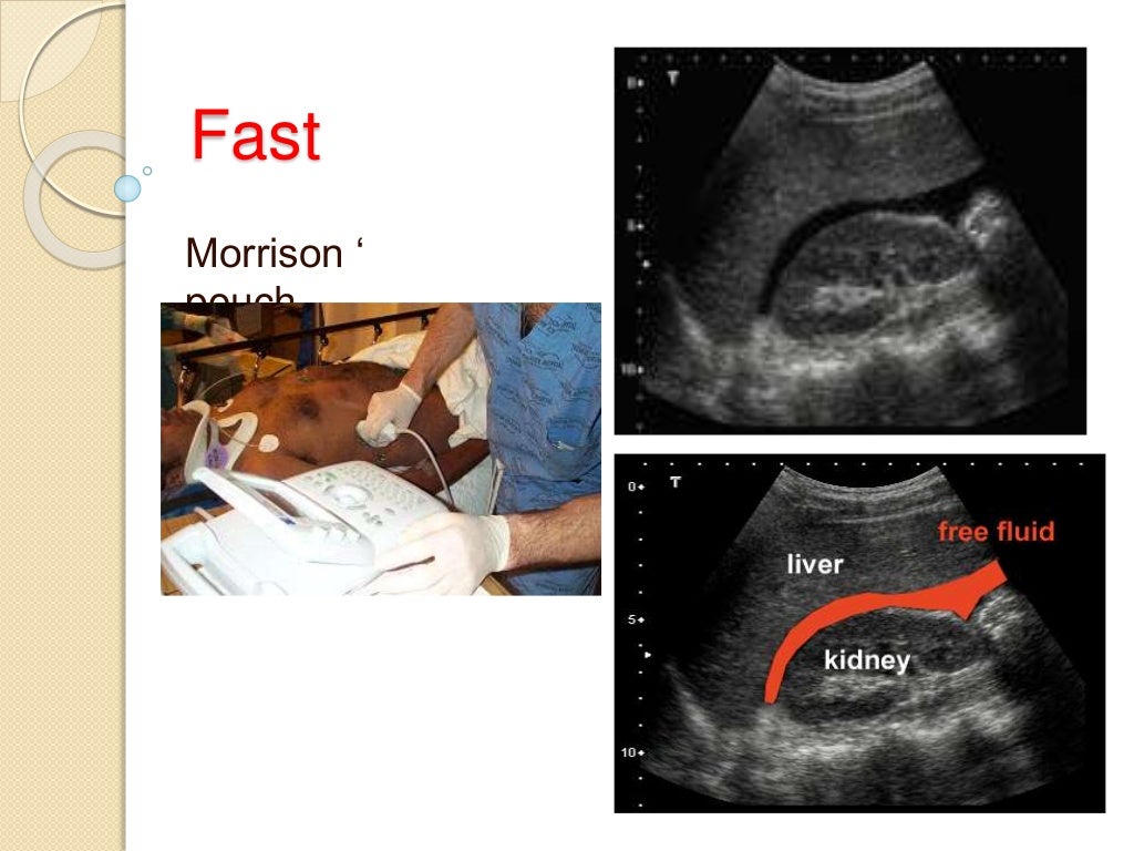 abdominal trauma abdominal trauma