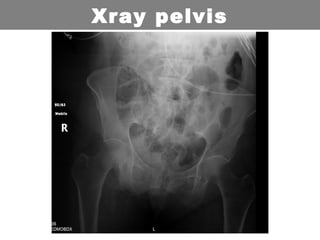 Xray pelvis
 