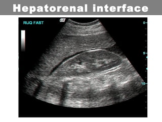 Hepatorenal interface
 