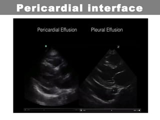 Pericardial interface
 