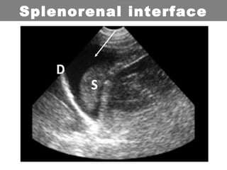 Splenorenal interface
 