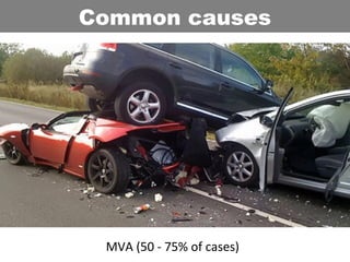MVA (50 - 75% of cases)
Common causes
 
