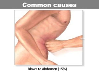 Blows to abdomen (15%)
Common causes
 