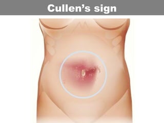 Cullen’s sign
 
