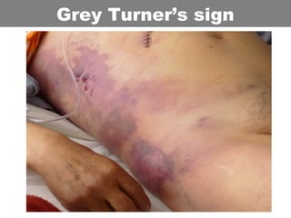Grey Turner’s sign
 