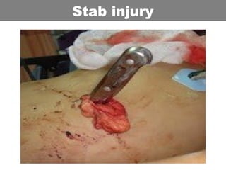 Stab injury
 