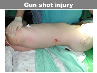 Gun shot injury
 