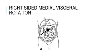 RIGHT SIDED MEDIAL VISCERAL
ROTATION
 