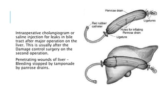 Intraoperative cholangiogram or
saline injection for leaks in bile
tract after major operation on the
liver. This is usually after the
Damage control surgery on the
second operation.
Penetrating wounds of liver –
Bleeding stopped by tamponade
by panrose drains.
 