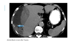Arterial Blush in Liver after Trauma
 