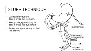 3TUBE TECHNIQUE
• Gastrostomy tube to
decompress the stomach,
• Retrograde jejunostomy to
decompress the duodenum
• Antegrade jejunostomy to feed
the patient
 