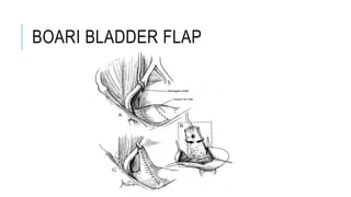 BOARI BLADDER FLAP
 