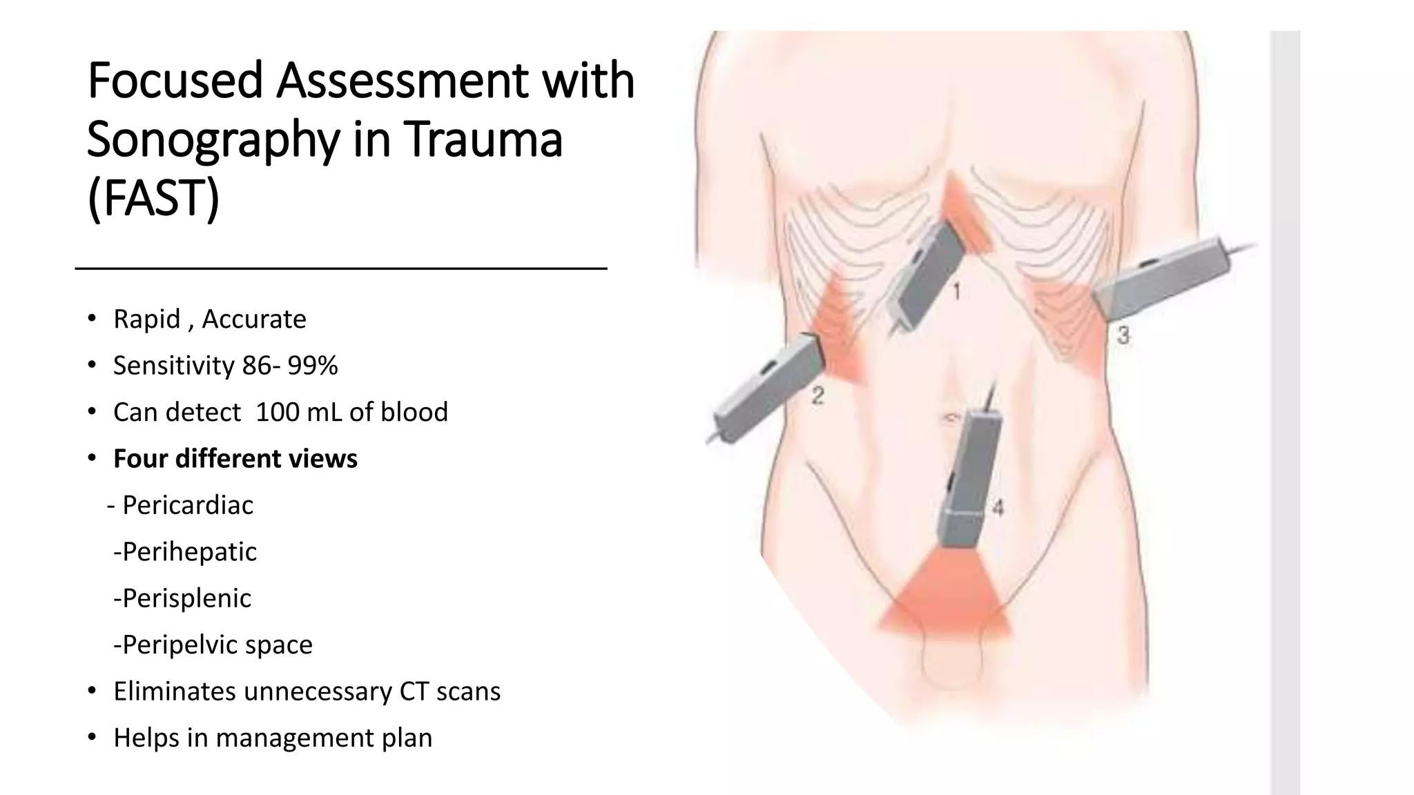 Abdominal trauma | PPTX
